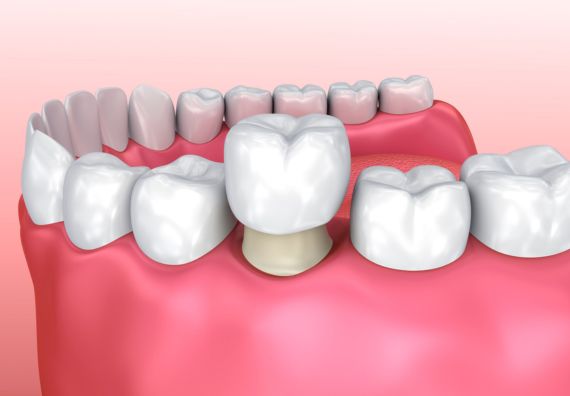 Dental Crowns in Goregaon