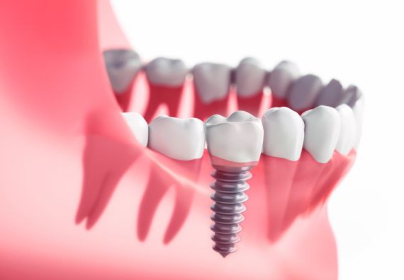 Dental Implants in Goregaon