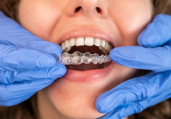 Clear Aligners in Goregaon