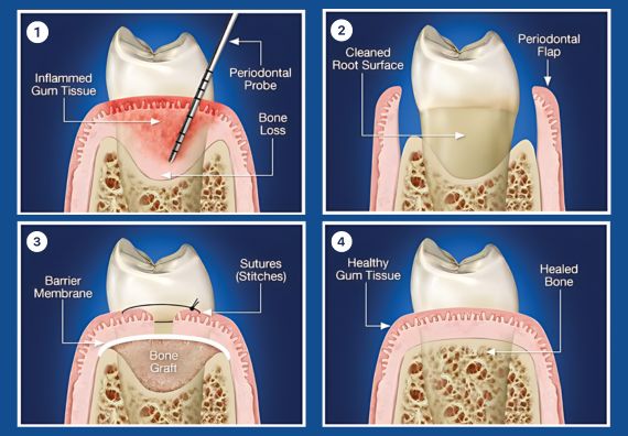 Gum Diseases Treatment in Goregaon