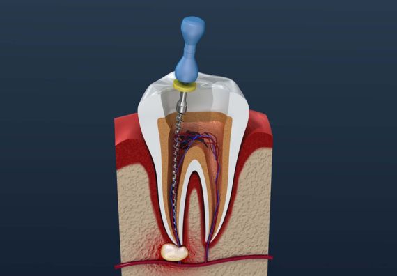 Root Canal Treatment in Goragaon