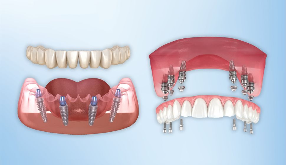 All on 4 & All on 6 implants in Goregaon