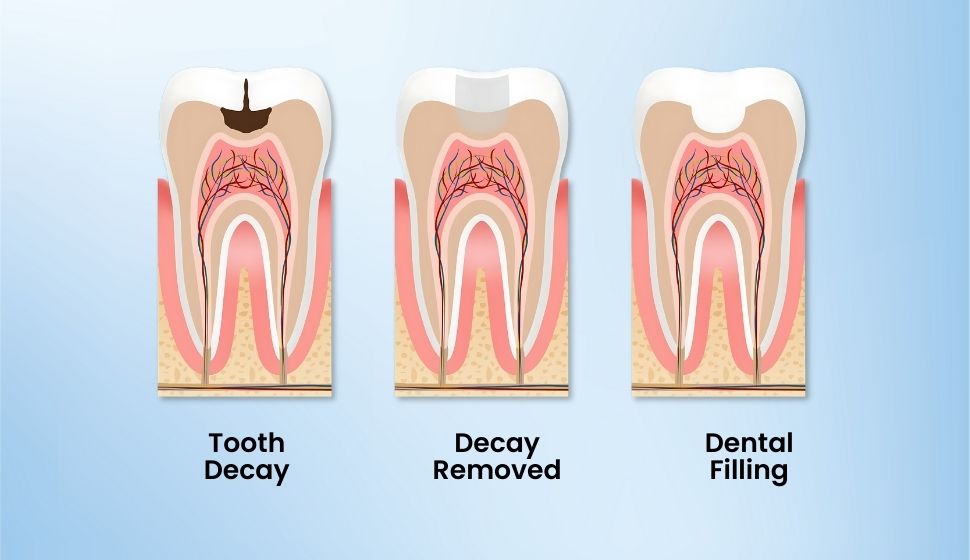 Tooth Cavity Filling