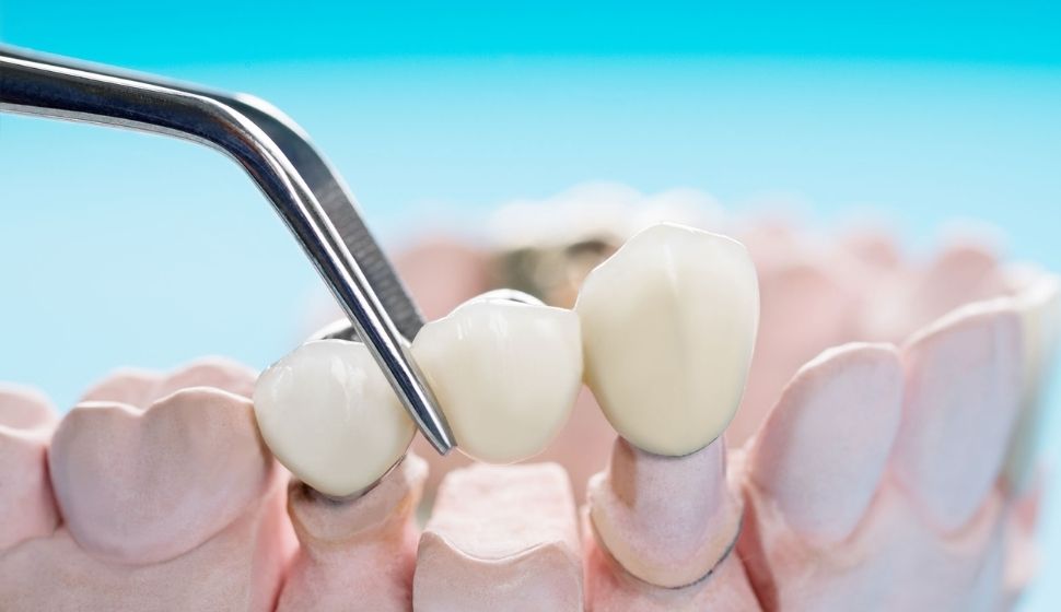 Dental Crown and Bridge Treatment In Goregaon | Dental Crown Cost in Goregaon