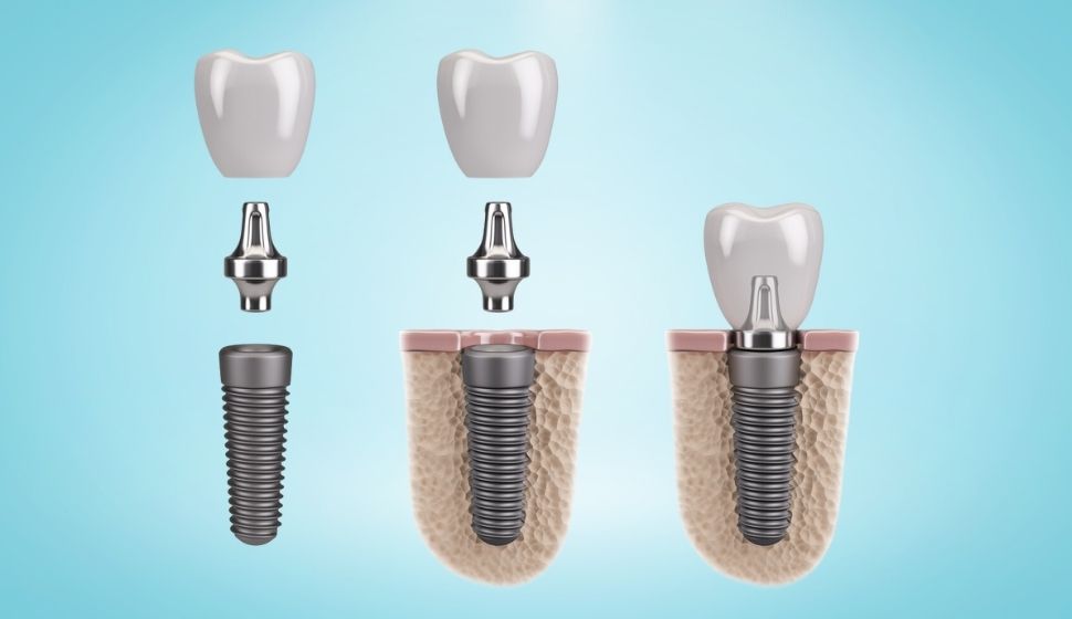 Dental Implant Treatment In Goregaon | Dental Implant Cost In Goregaon