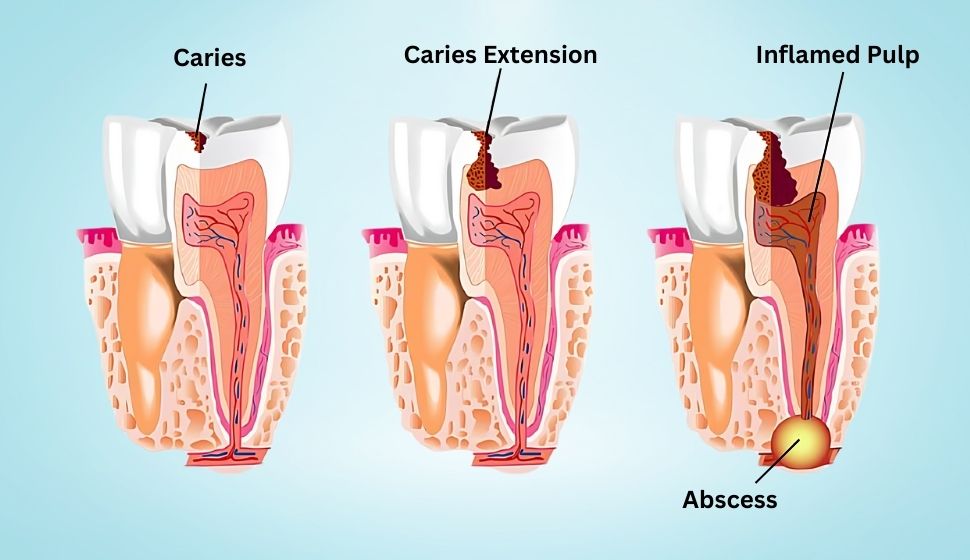 Root Canal Treatment in Goregaon