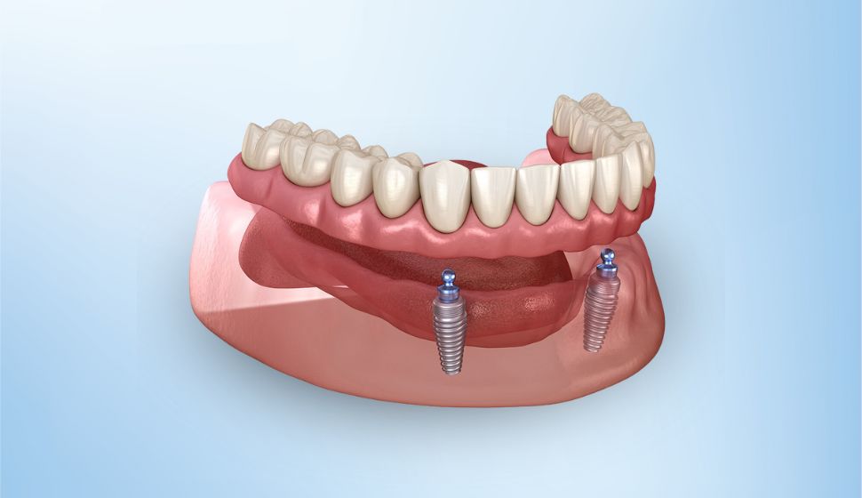 Over Dentures Cost In Goregaon